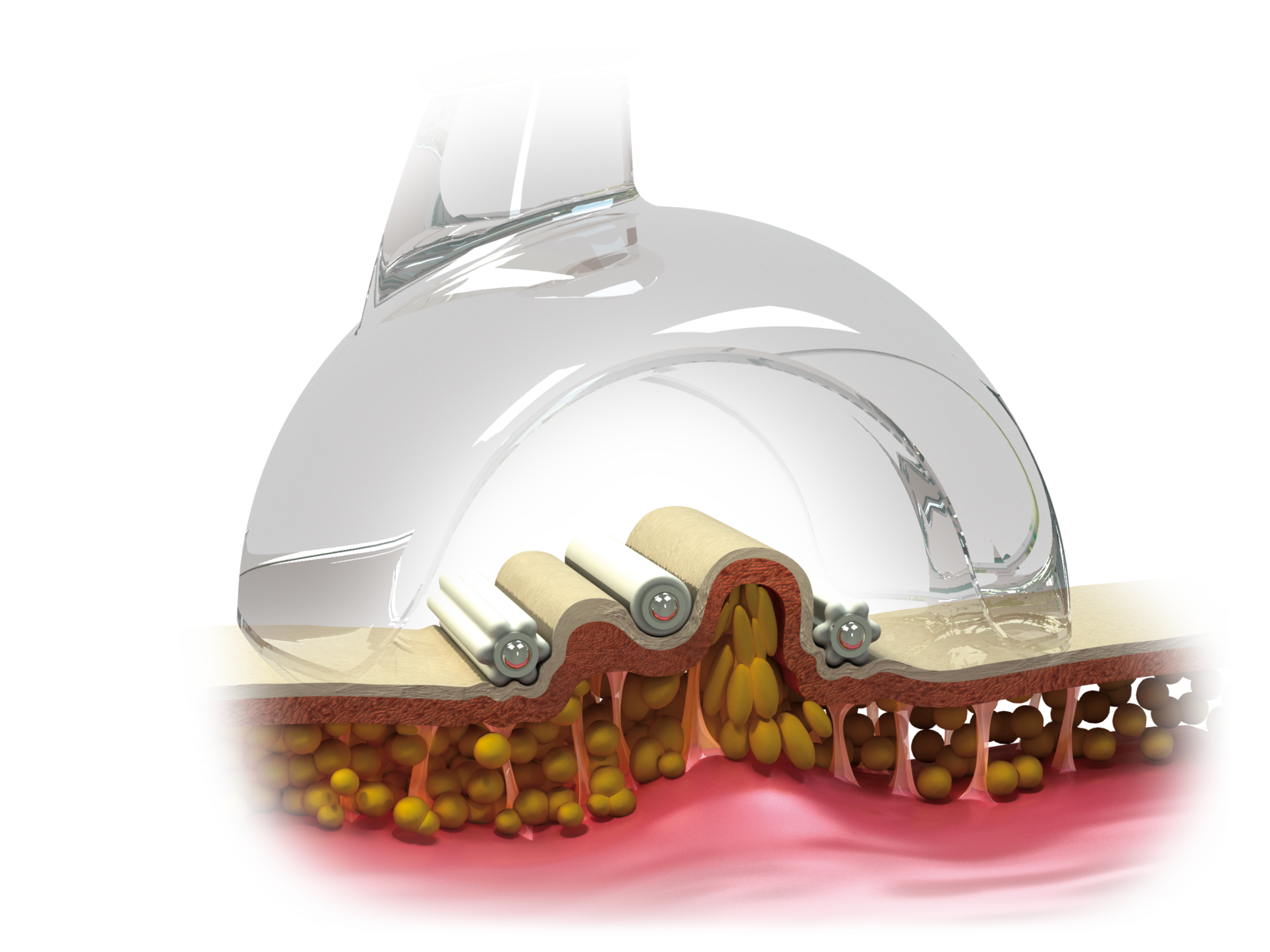 Вакуумно-роликовый массажер Starvac DXtwin Santreyd MED-175 - Вид №6